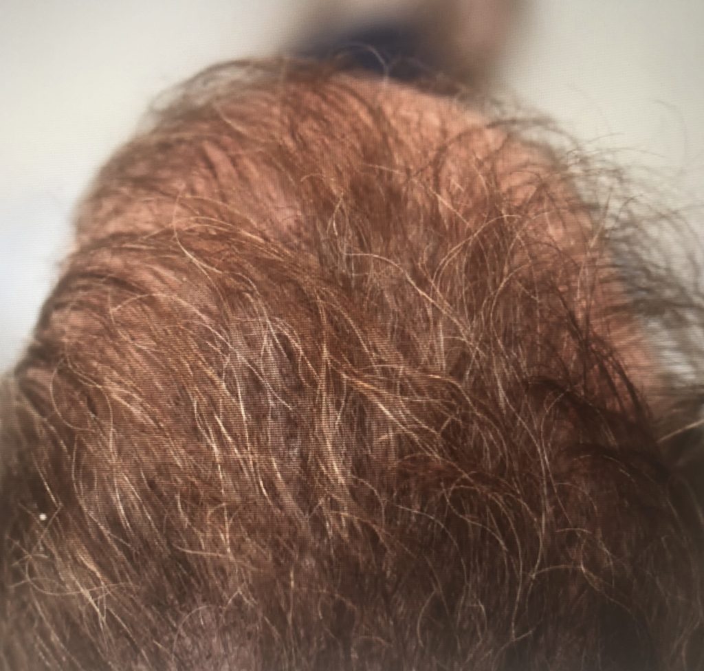 scalp micro pigmentation after