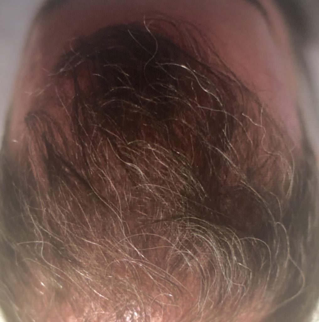 scalp micro pigmentation before